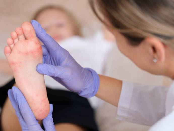 Pieds-mains-bouche : comprendre cette maladie infantile